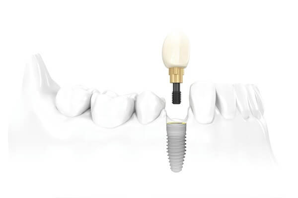 Người mất răng nên làm cầu răng hay Implant?