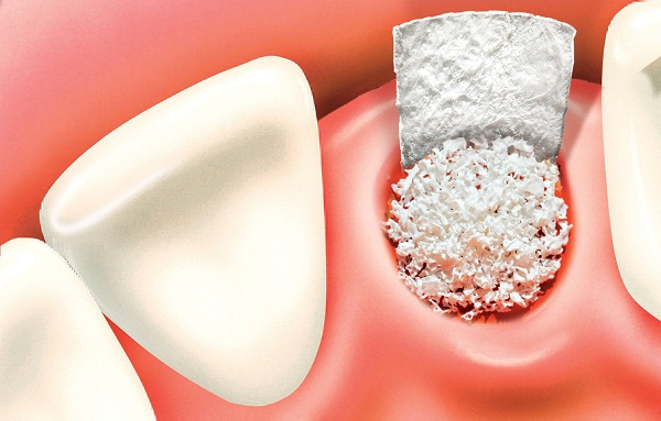 Cấy ghép xương trong trồng răng implant