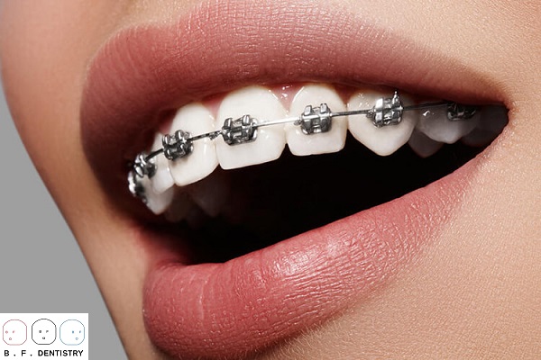 Niềng răng có cần nhổ răng không? Nếu nhổ thì nhổ những răng nào?